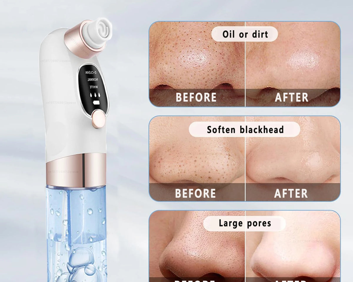 Blackhead Remover Pore Vacuum Face Cleaner